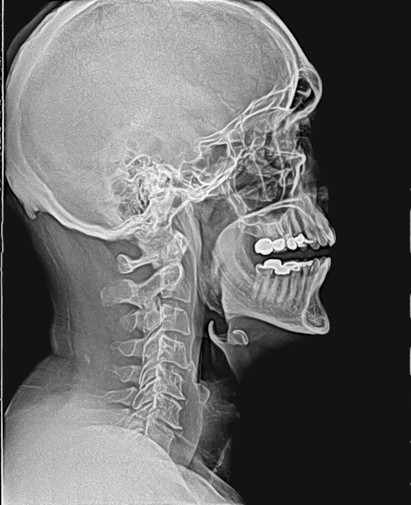 X-ray image of a human skull and spine.