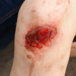 Injured knee with visible wound and blood.