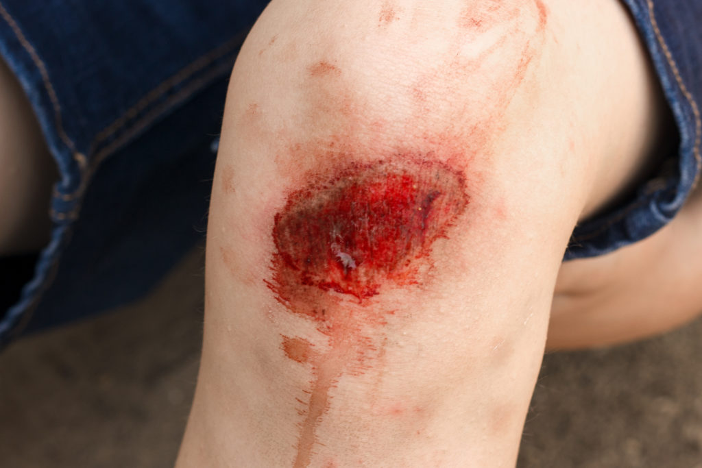 Injured knee with visible wound and blood.